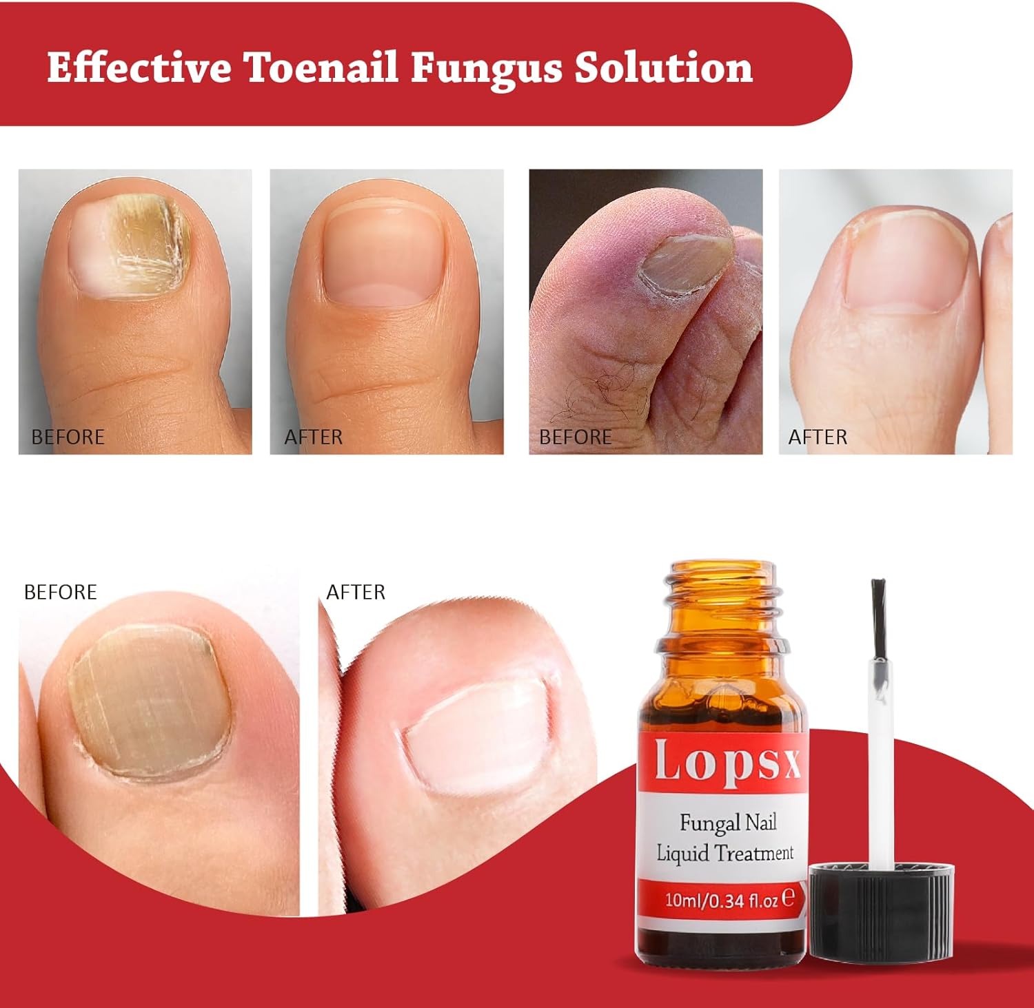 Fungal Nail Liquid Treatment
